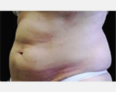 CoolSculpting Before & After Gallery - Patient 5884015 - Image 1