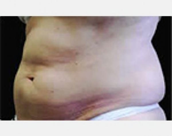 CoolSculpting Before & After Gallery - Patient 5884015 - Image 1
