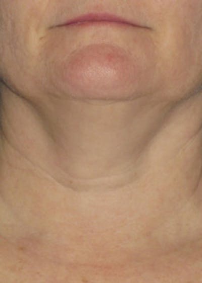 Ultherapy Before & After Gallery - Patient 5884018 - Image 1