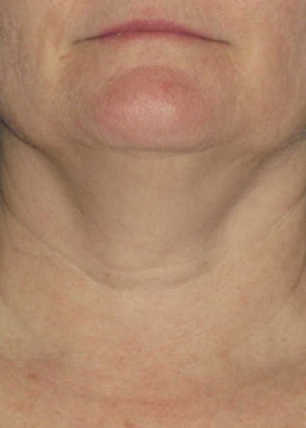 Ultherapy Gallery - Patient 5884018 - Image 1