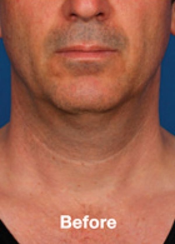 Kybella Before & After Gallery - Patient 5884017 - Image 1