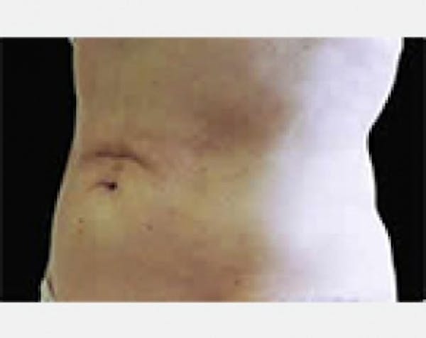 CoolSculpting Before & After Gallery - Patient 5884015 - Image 2