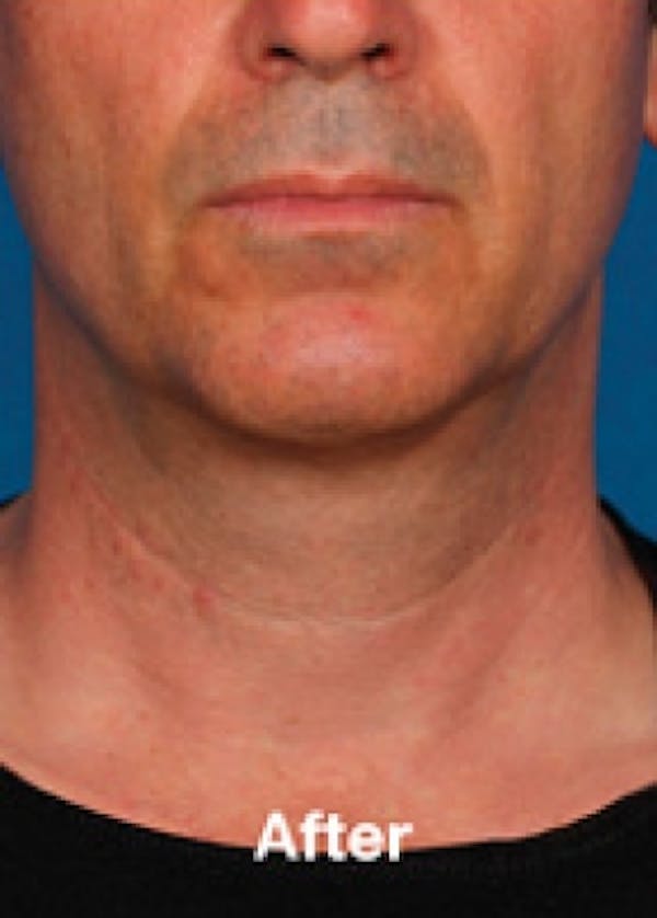 Kybella Before & After Gallery - Patient 5884017 - Image 2