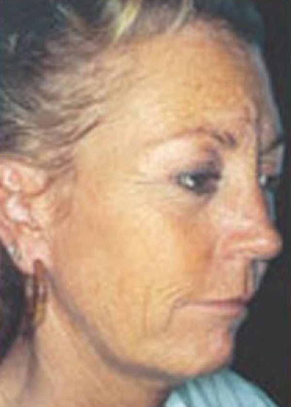 Skin Peels Before & After Gallery - Patient 5884021 - Image 1
