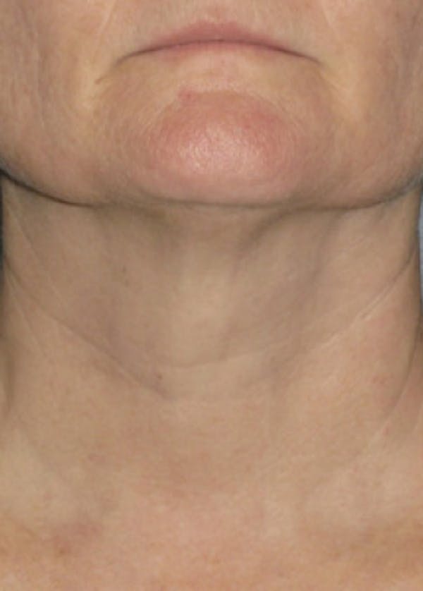 Ultherapy Before & After Gallery - Patient 5884018 - Image 2