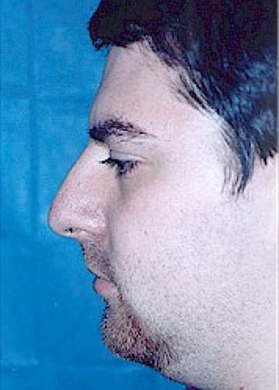 Rhinoplasty Before & After Gallery - Patient 5884020 - Image 1