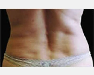 CoolSculpting Before & After Gallery - Patient 5884019 - Image 2