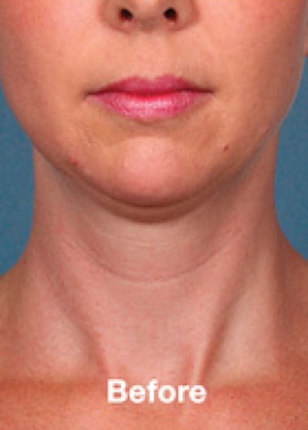 Kybella Before & After Gallery - Patient 5884022 - Image 1