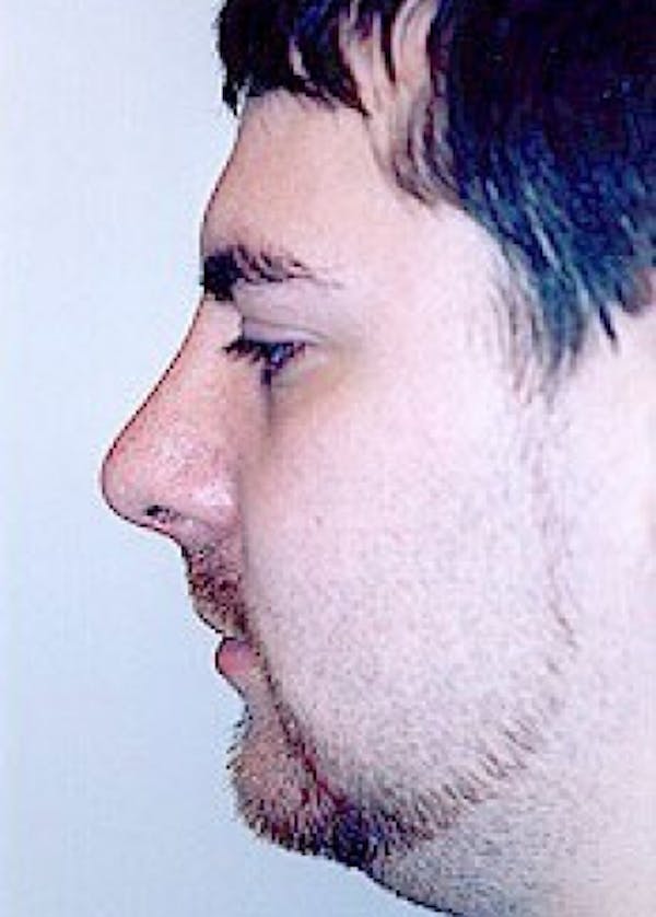 Rhinoplasty Before & After Gallery - Patient 5884020 - Image 2