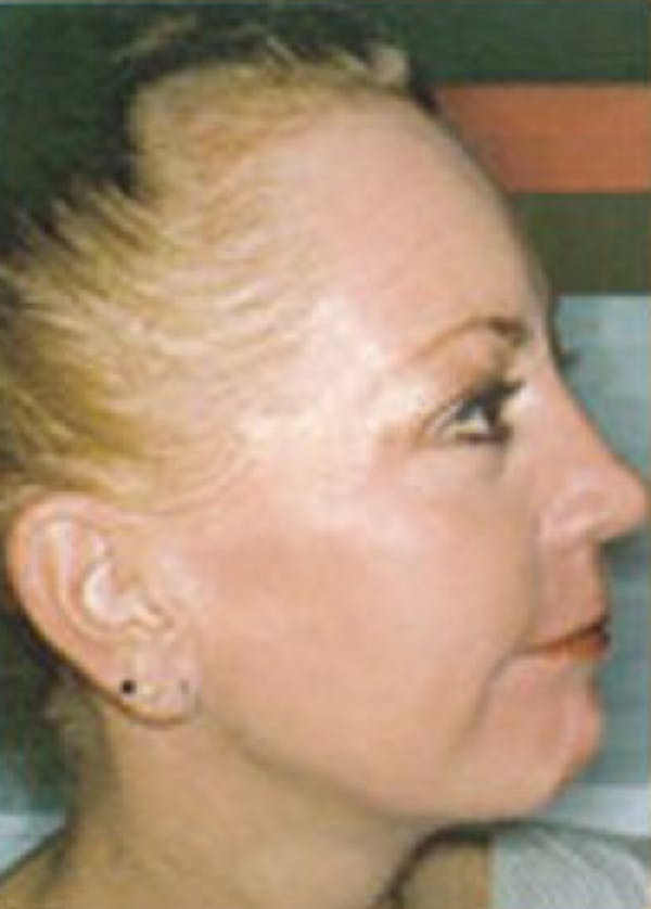 Skin Peels Before & After Gallery - Patient 5884021 - Image 2