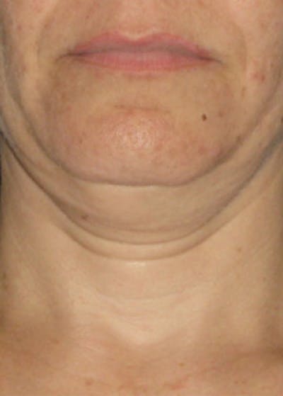 Ultherapy Before & After Gallery - Patient 5884024 - Image 1