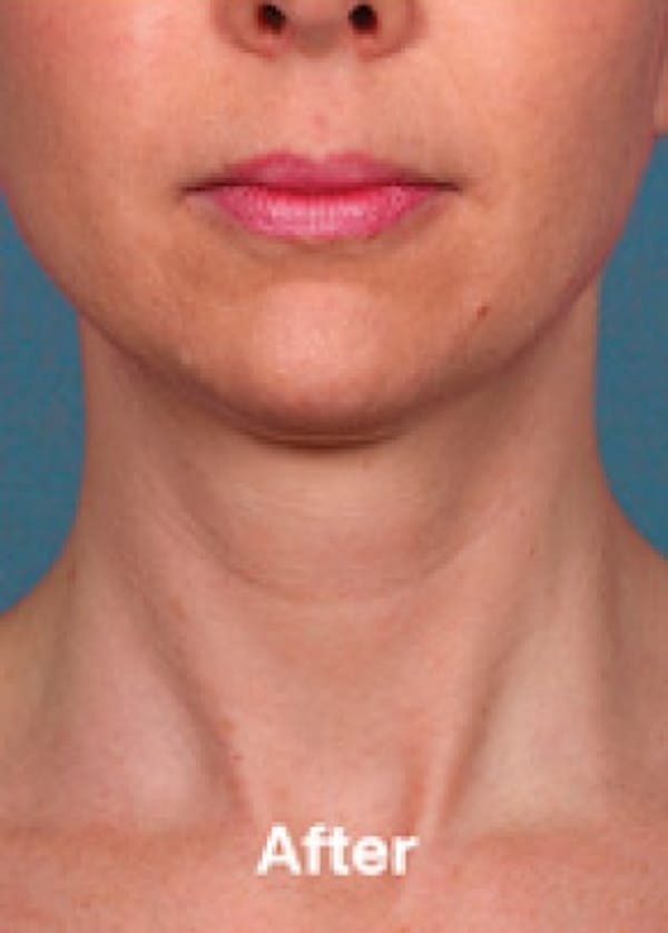 Kybella Before & After Gallery - Patient 5884022 - Image 2