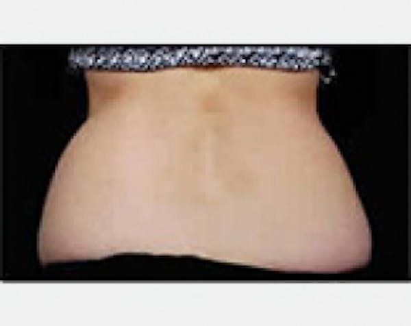 CoolSculpting Gallery - Patient 5884023 - Image 1