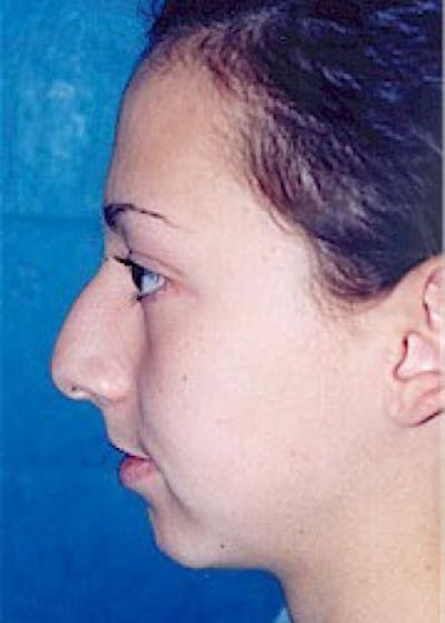 Rhinoplasty Before & After Gallery - Patient 5884025 - Image 1