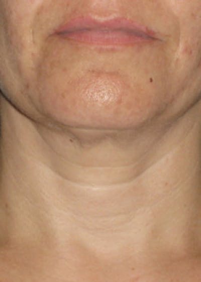 Ultherapy Gallery - Patient 5884024 - Image 2