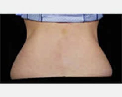 CoolSculpting Before & After Gallery - Patient 5884023 - Image 2