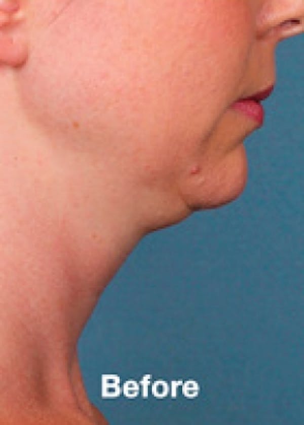 Kybella Before & After Gallery - Patient 5884026 - Image 1