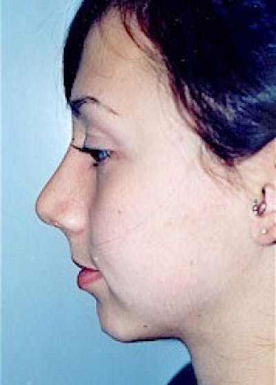 Rhinoplasty Before & After Gallery - Patient 5884025 - Image 2