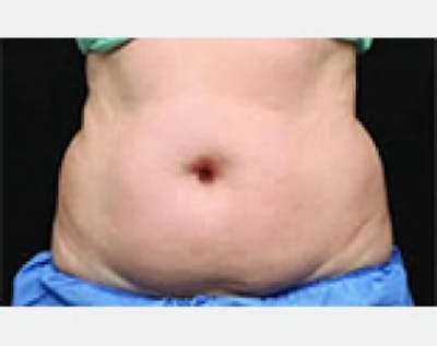 CoolSculpting Before & After Gallery - Patient 5884027 - Image 1