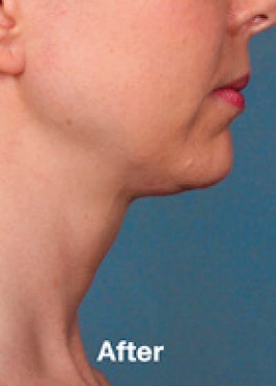 Kybella Before & After Gallery - Patient 5884026 - Image 2