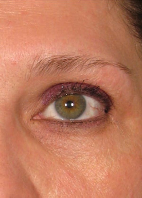 Ultherapy Before & After Gallery - Patient 5884028 - Image 1