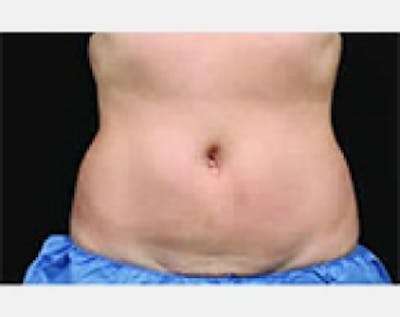 CoolSculpting Before & After Gallery - Patient 5884027 - Image 2