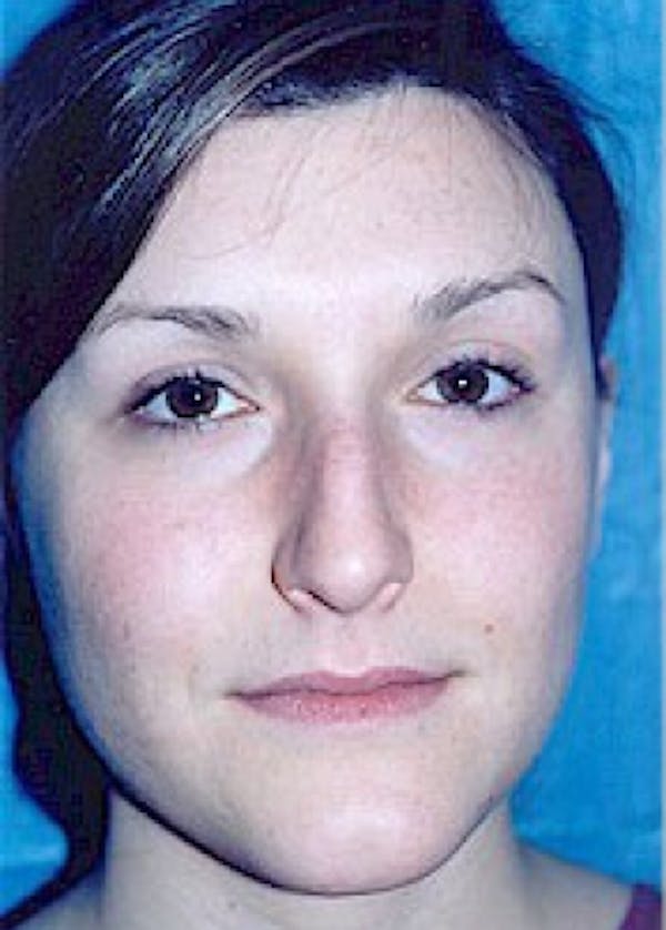 Rhinoplasty Before & After Gallery - Patient 5884033 - Image 1