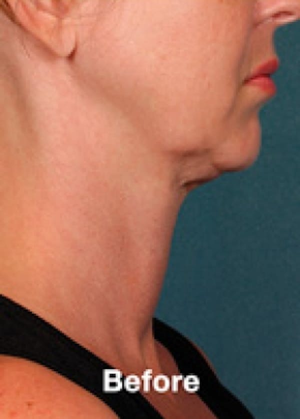 Kybella Before & After Gallery - Patient 5884029 - Image 1