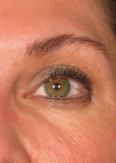 Ultherapy Before & After Gallery - Patient 5884028 - Image 2