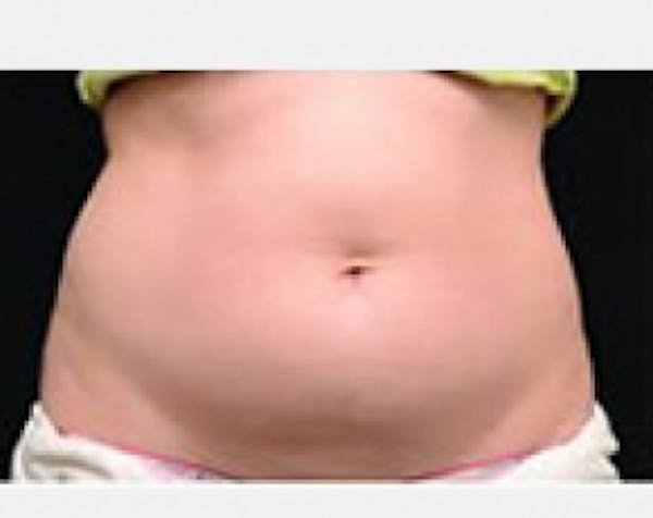 CoolSculpting Gallery - Patient 5884030 - Image 1
