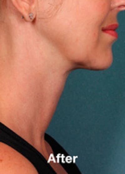 Kybella Before & After Gallery - Patient 5884029 - Image 2