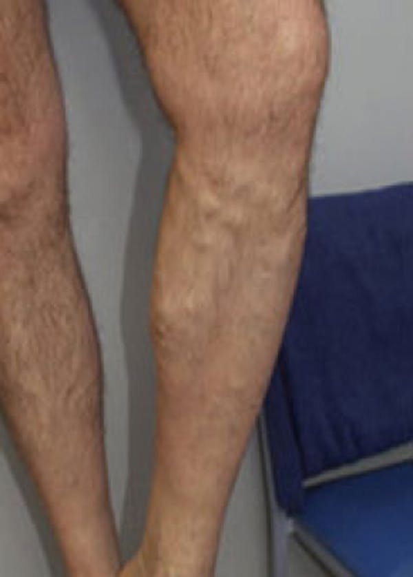 Spider Vein Removal Before & After Gallery - Patient 5884031 - Image 1