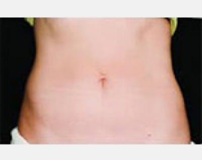 CoolSculpting Gallery - Patient 5884030 - Image 2