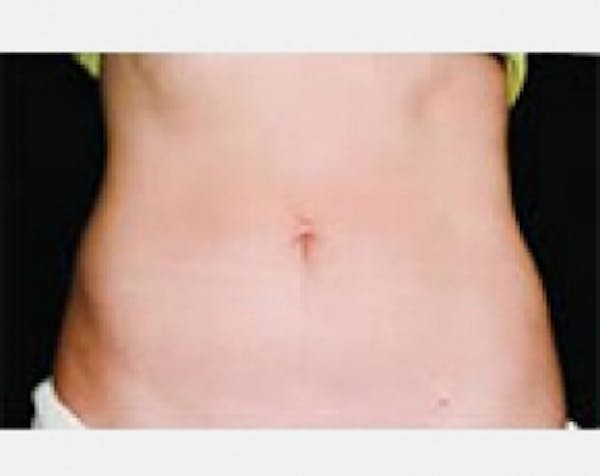 CoolSculpting Before & After Gallery - Patient 5884030 - Image 2