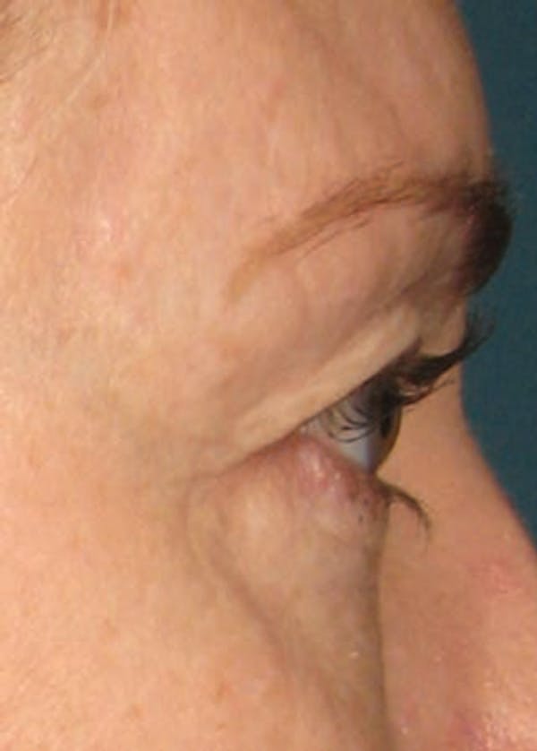 Ultherapy Before & After Gallery - Patient 5884035 - Image 1