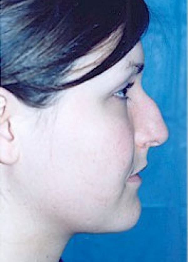 Rhinoplasty Before & After Gallery - Patient 5884033 - Image 3