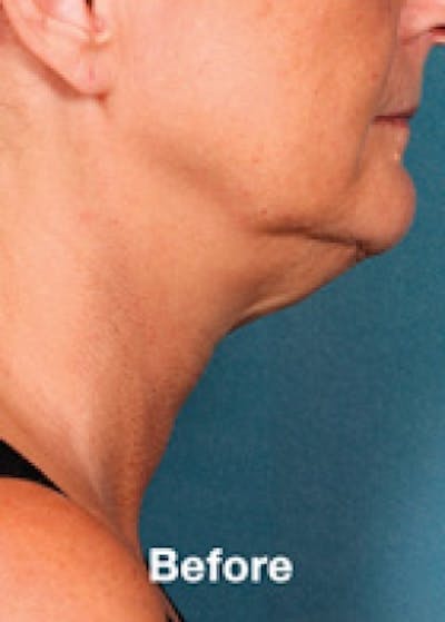 Kybella Before & After Gallery - Patient 5884032 - Image 1