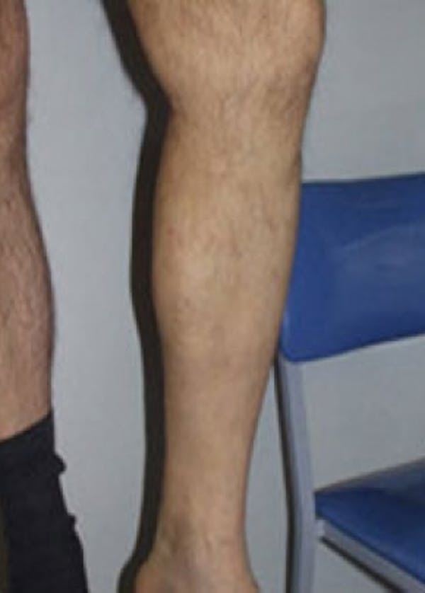Spider Vein Removal Before & After Gallery - Patient 5884031 - Image 2