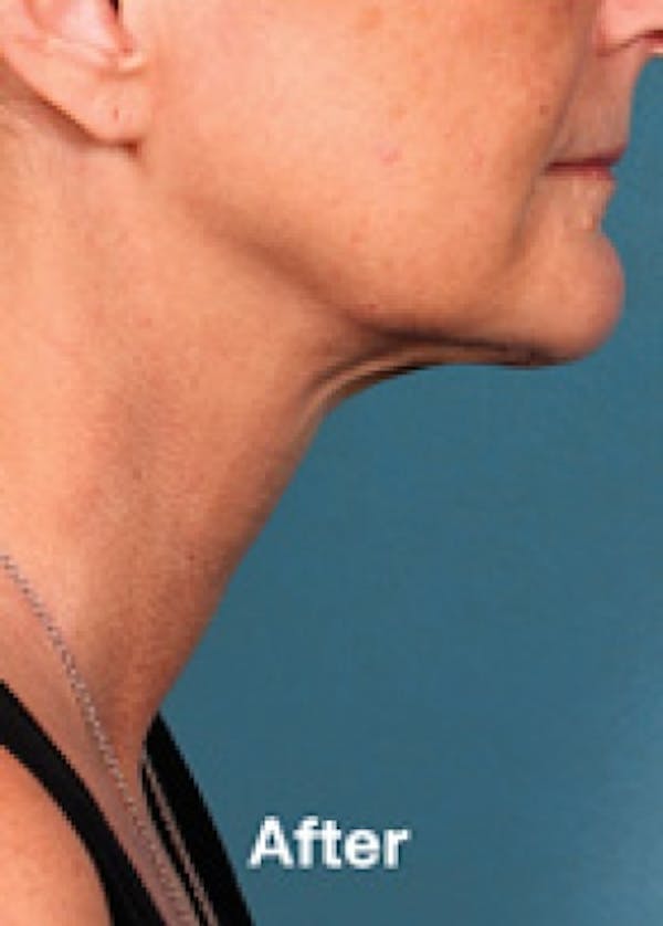 Kybella Before & After Gallery - Patient 5884032 - Image 2