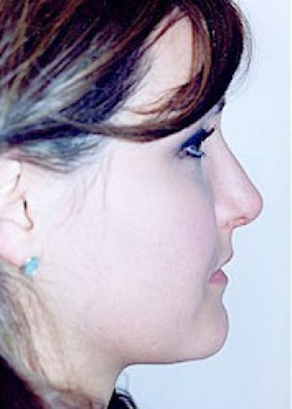Rhinoplasty Before & After Gallery - Patient 5884033 - Image 4