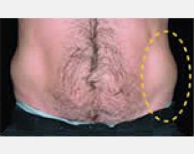 CoolSculpting Before & After Gallery - Patient 5884034 - Image 1