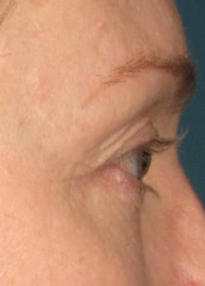 Ultherapy Before & After Gallery - Patient 5884035 - Image 2