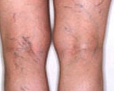 Spider Vein Removal Before & After Gallery - Patient 5884036 - Image 1