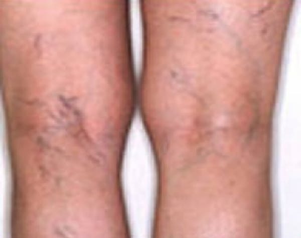 Spider Vein Removal Before & After Gallery - Patient 5884036 - Image 1