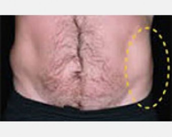 CoolSculpting Before & After Gallery - Patient 5884034 - Image 2
