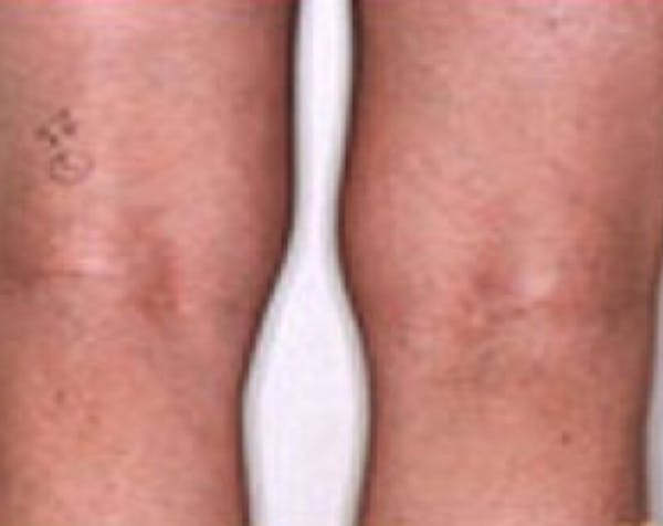 Spider Vein Removal Before & After Gallery - Patient 5884036 - Image 2
