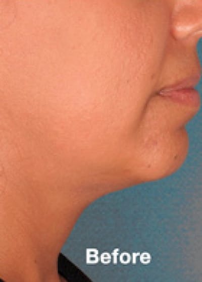 Kybella Before & After Gallery - Patient 5884037 - Image 1
