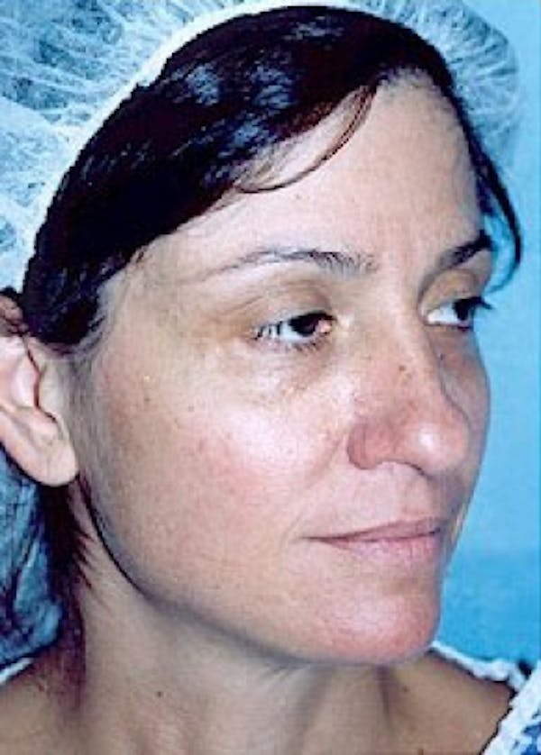 Rhinoplasty Before & After Gallery - Patient 5884041 - Image 1