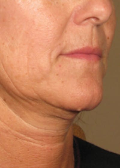 Ultherapy Before & After Gallery - Patient 5884039 - Image 1