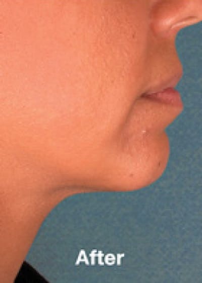 Kybella Before & After Gallery - Patient 5884037 - Image 2